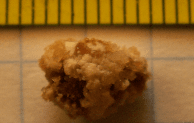 “보석이다!” 싹 챙긴 도둑들 ‘반전’…알고 보니 몸속 ‘신장 결석’이었다