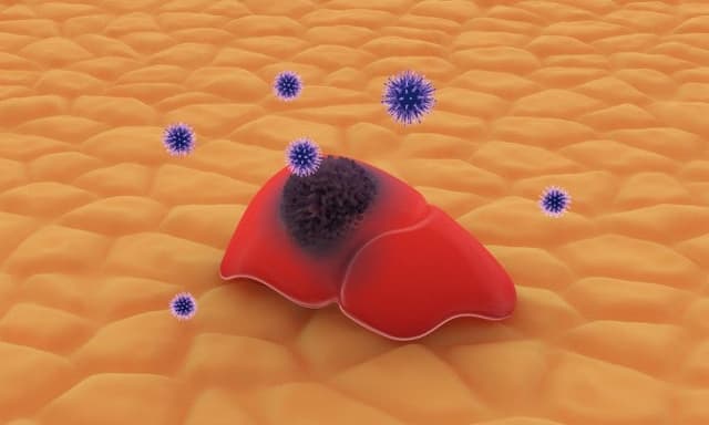 전기 소작으로 간암 면역억제 풀어…CAR-NK 치료효과 높였다
