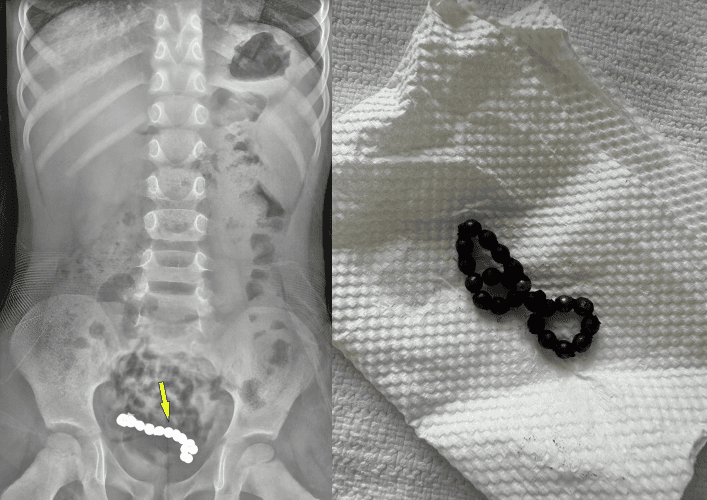 “1년동안 배 아파” 4세 남아…뱃속에 ‘자석 22개’ 들어있었다