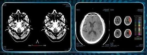 제이엘케이, "비조영CT 뇌졸중 분석 솔루션" 美 FDA 시판허가 획득