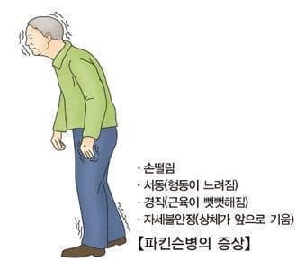 파킨슨병 환자 중 '시각·공간 인지 저하' 유형, 치매 위험 7.3배 높아