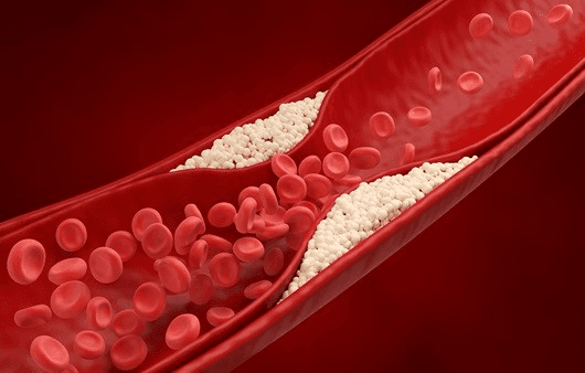 동맥경화 환자, "콜레스테롤 수치 '기존보다 더 낮게' 관리"하면 심근경색 위험 30% 감소