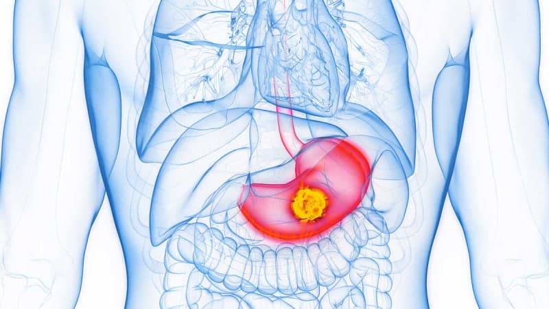 "위암 세포 키우는 단백질 찾았다"…억제하니 암세포 성장 '뚝'