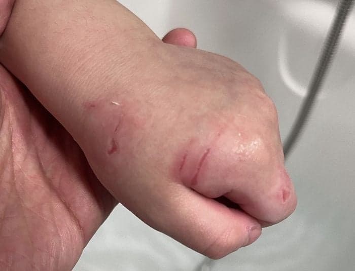 "시끄럽다고 4살 아이 밀치고 손 할퀴었다"…어린이집 교사, 아동학대 의혹 제기