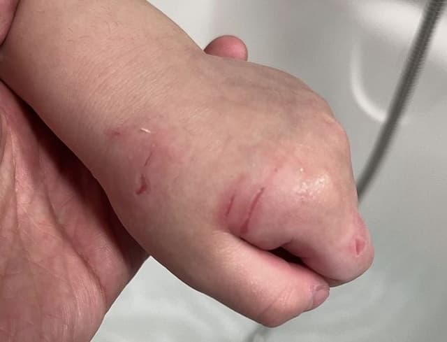 "시끄럽다고 4살 아이 밀치고 손 할퀴었다"…어린이집 교사, 아동학대 의혹 제기