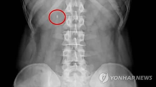 "옆구리가 쿡쿡 쑤신다면"…봄철 늘어나는 요로결석, 단순 근육통 아닐 수 있다