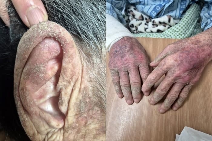 “옴 진단에도 격리·치료 없었다”…요양센터 방치에 90대 노인 사망