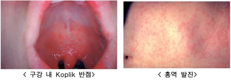 동남아 홍역 23배 급증, 국내 환자 67% 해외 유입…“숨만 쉬어도 감염”