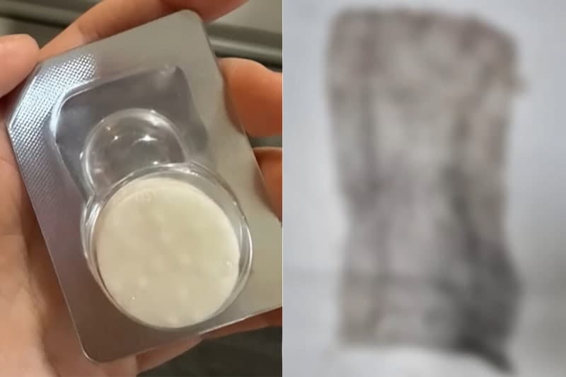 자궁 시술 후 손바닥만 한 거즈가 몸속에…경찰은 의사 '무혐의' 처분