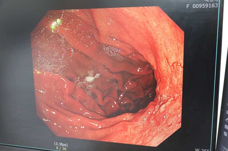 위암 재발 10명 중 7명, '수술 후 2년 내' 발생…완치했어도 '헬리코박터균' 없애야