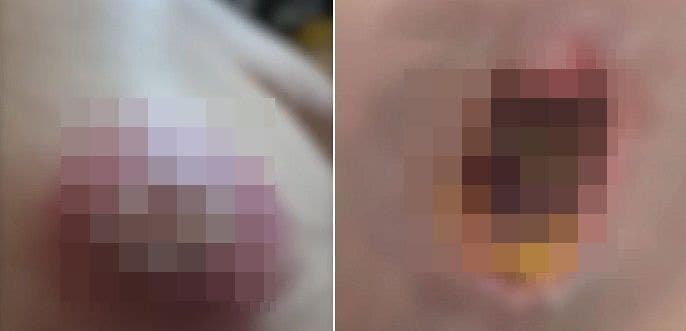 “피부 괴사됐다” 잠든 사이 마음대로 점 뺀 中 마사지사, 황당 서비스