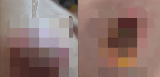 마사지숍서 잠든 사이 '점 제거'…中 마사지사 무단 시술에 피부 '괴사' 절제 수술
