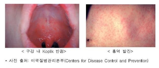 "첫 백신도 못 맞았는데"…방글라데시 홍역 확산, 두 달새 어린이 424명 사망