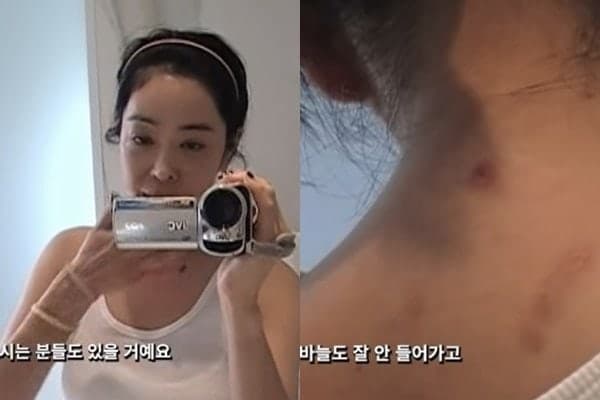 "달라진 얼굴·온몸 흉터 투성이"…이혜영, 폐암 투병 5년 만 근황 공개