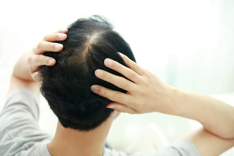 정은경 "탈모치료 건보 확대 추진…20~34세 대상"