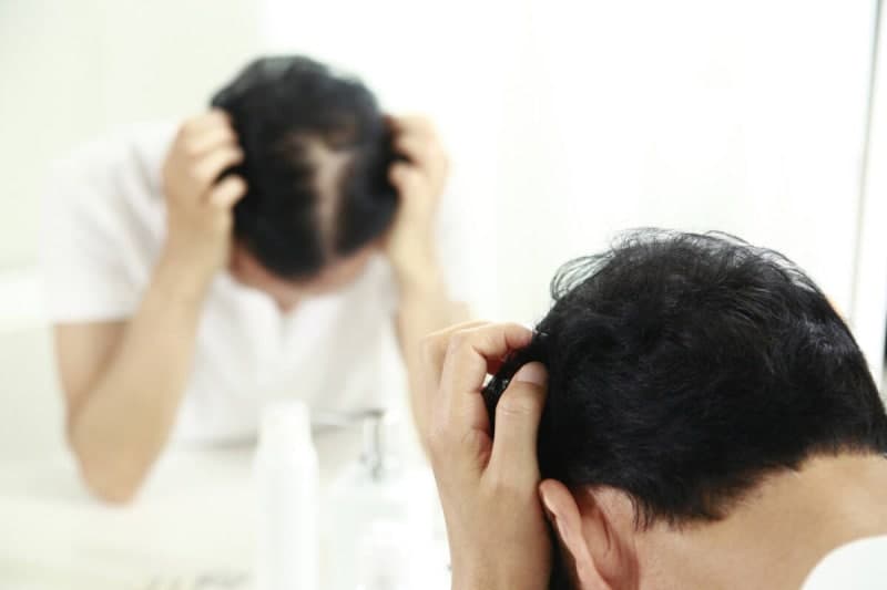 7월부터 중증 원형 탈모 치료제 건강보험 급여 확대, 최대 2년 지원