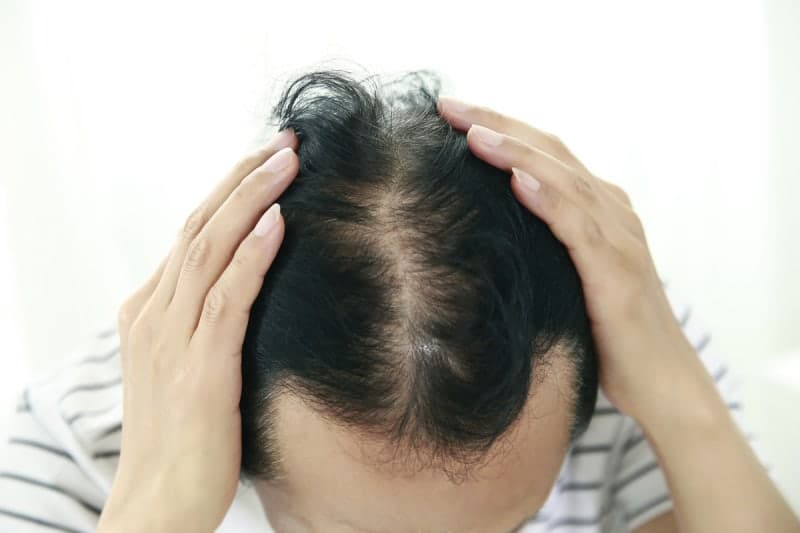 “취업·결혼 걸렸다” vs “건보 재정 부담”…탈모약 건보 적용 논란 재점화, 연 1800억 필요