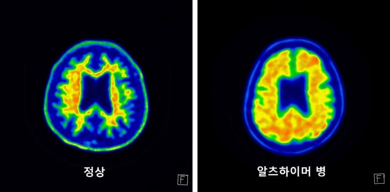 서울성모병원, 알츠하이머 항체치료 200례 달성…정밀치매 치료 선도