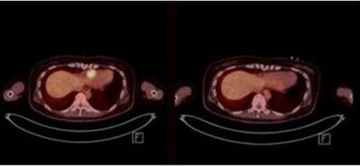 큐로셀 토종1호 CAR-T 치료제 '림카토' 암질심 통과, 급여 문턱 넘었다