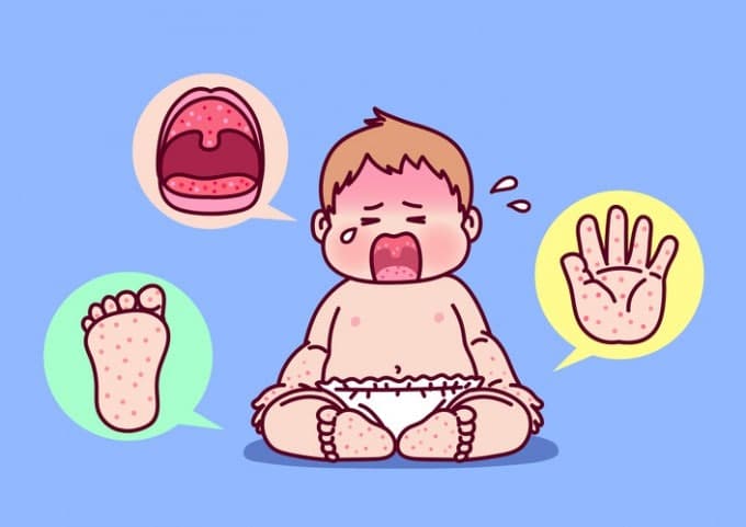 수족구병 한 달 새 2배 급증…질병청 "영유아, 완전히 나을 때까지 등원 자제"