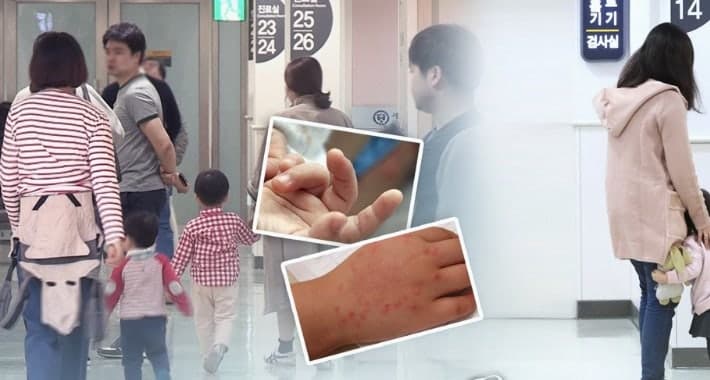 대전 영유아 수족구병 확산세…지난해 대비 2배 급증