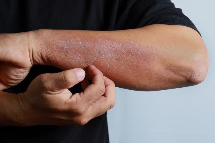 여름철 땀과 자외선에 무너지는 피부장벽, 습진 예방하려면