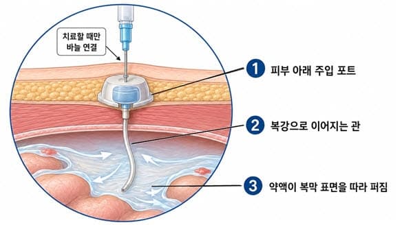 복막전이 4기 위암, 항암제 직접 투여했더니 환자 40% 수술 길 열렸다