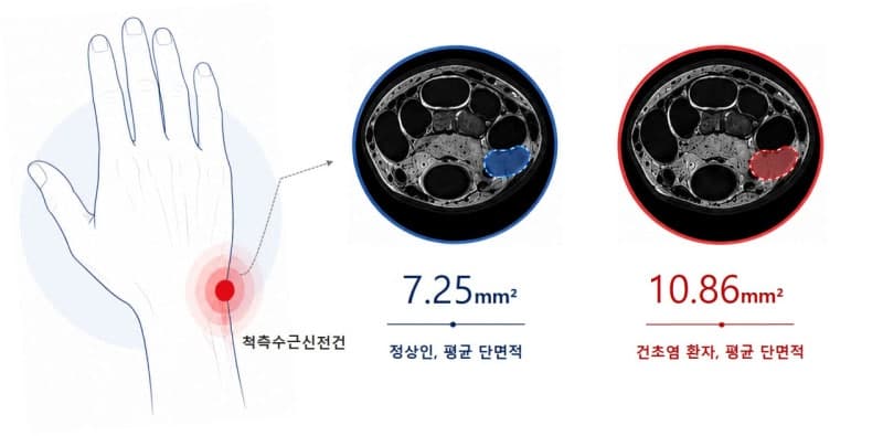 국제성모병원 김영욱 교수팀, 손목 힘줄염 객관적 MRI 진단 기준 제시