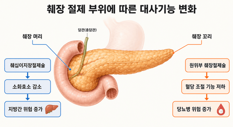 췌장 수술 후 당뇨·지방간 위험 낮추는 맞춤형 치료 전략 나왔다
