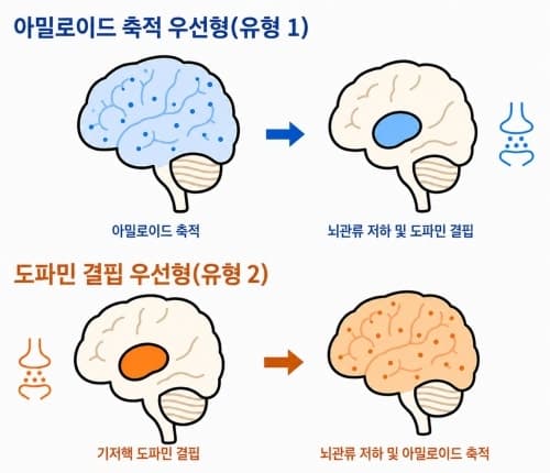 루이소체치매, 두 가지 진행 경로 확인…맞춤형 치료 길 열린다