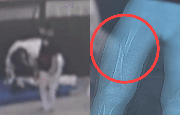 태권도장서 강제 '다리 찢기' 당한 7세 아동 허벅지뼈 골절