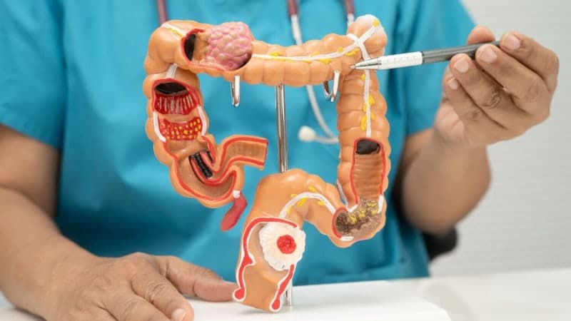 치료제 없는 말기 대장암, 환자 면역세포 활용 임상연구 길 열렸다