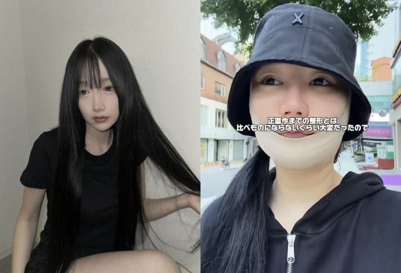 한국서 양악 수술 받은 日 인플루언서, 3개월째 입·턱 마비 고통 호소